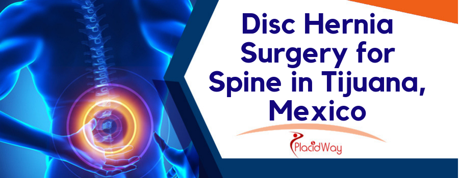 Disc Hernia Surgery in Tijuana, Mexico